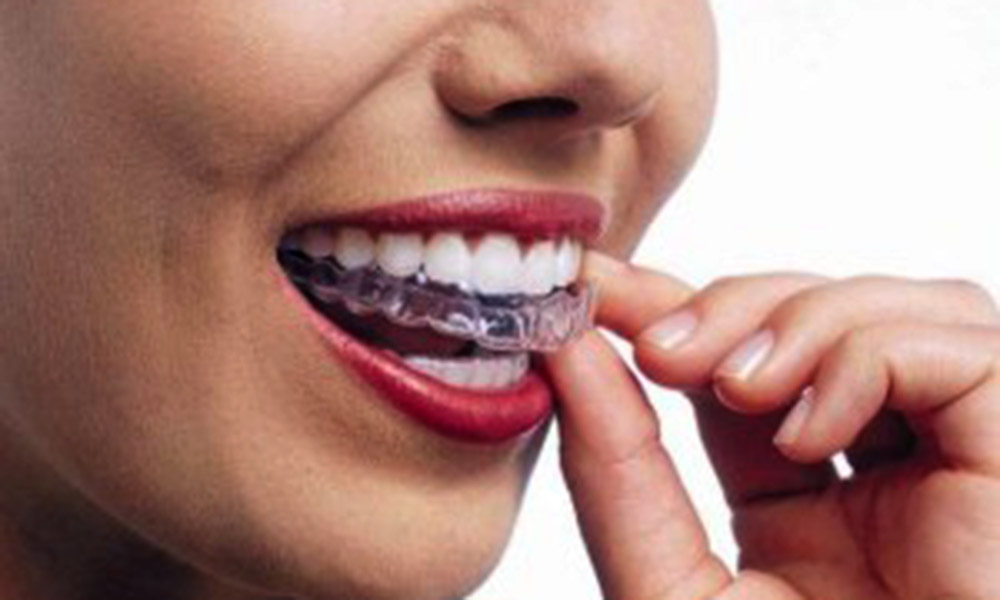 Plaque occlusive | Clinique de denturologie Lelièvre | Spécialiste en prothèse dentaire